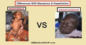 differences between marasmus and kwashiorkor