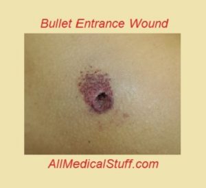 bullet entrance wound